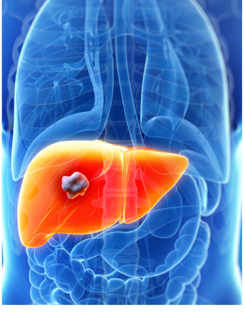 Liver Cancer Treatment